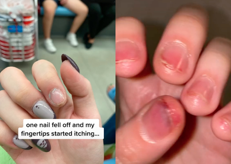 itchy-fingers-woman-says-manicure-gave-her-blisters-and-pus-singapore